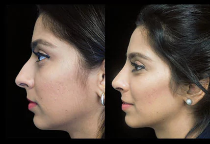 A client before and after rhinoplasty